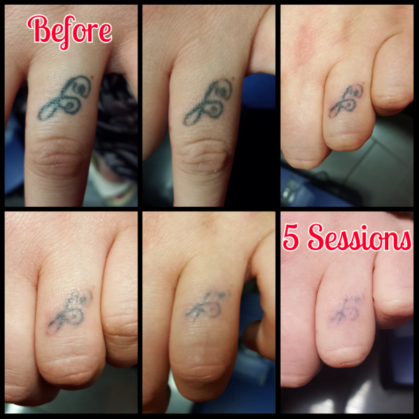 Pulse Tattoo & Piercing | Tattoo removal
